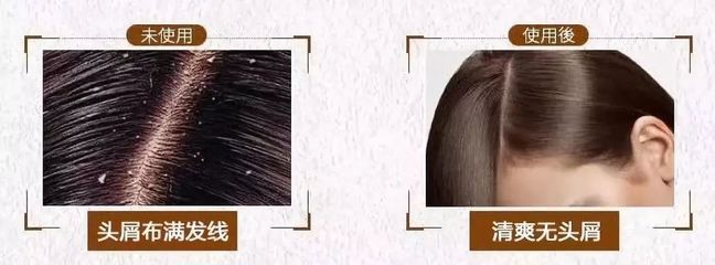 告別脫發、頭皮屑與頭發稀少的煩惱，重塑烏黑濃密的秀發